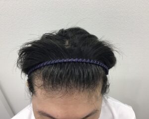 AGA治療前 43歳男性 生え際薄毛 新潟院