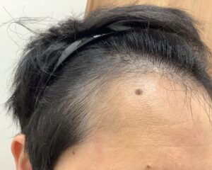 AGA治療後＿25歳男性＿生え際・頭頂部の改善＿広島院