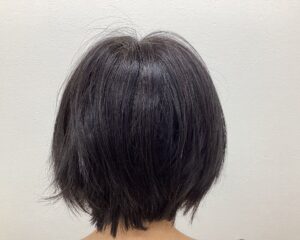 FAGA治療8ヵ月目 49歳女性 分け目の薄毛 横浜院