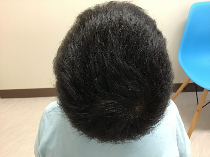 円形脱毛症治療開始1年2ヶ月後　5歳男児　汎発型　鹿児島院