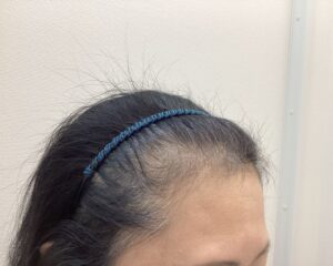FAGA治療前　57歳女性　生え際・分け目薄毛　新潟院