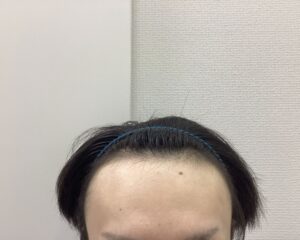 AGA治療前　27歳男性　生え際薄毛　新潟院