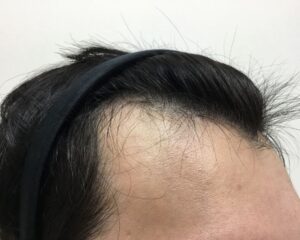 AGA治療前　23歳男性　前頭部薄毛　大阪梅田院