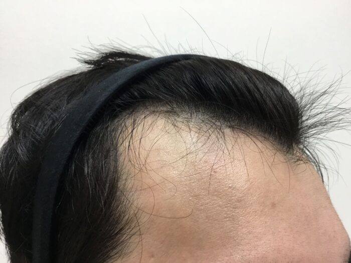 【23歳男性】生え際の薄毛がAGA治療で改善｜大阪梅田院