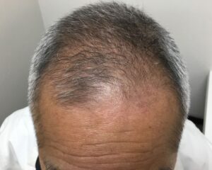 AGA治療前＿68歳男性＿生え際・頭頂部の薄毛＿大阪梅田院