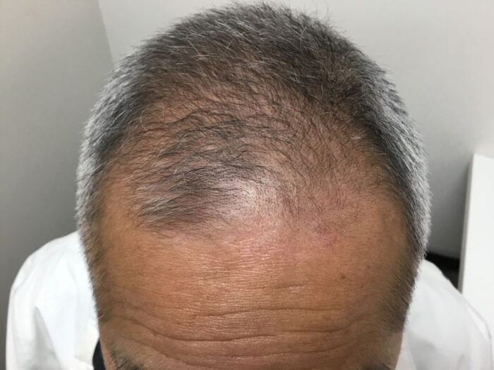 【68歳男性】生え際・頭頂部の薄毛がAGA治療で改善｜大阪梅田院