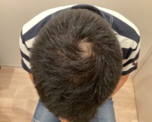 AGA治療前＿40歳男性＿生え際・頭頂部の薄毛＿大阪梅田院