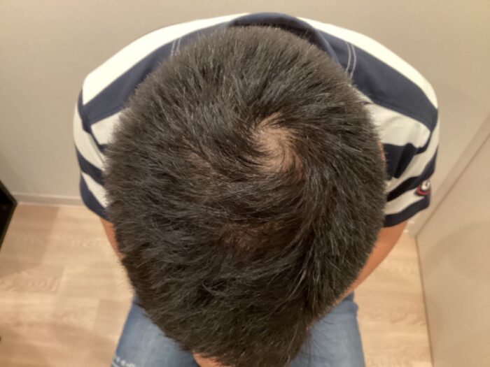 【40歳男性】生え際・頭頂部の薄毛がAGA治療で改善｜大阪梅田院