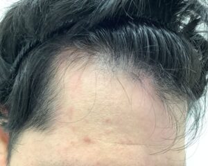 AGA治療前＿38歳男性＿生え際・頭頂部の薄毛＿広島院
