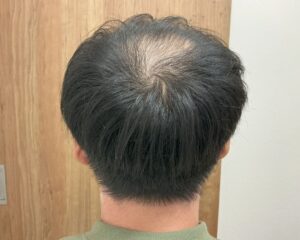 AGA治療前_29歳男性_生え際・頭頂部の薄毛_広島院