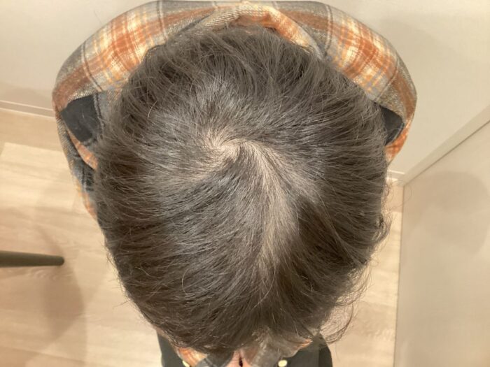 AGA治療前＿25歳男性＿頭頂部薄毛＿大阪梅田院