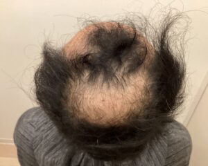 AGA治療前＿48歳男性＿生え際・頭頂部薄毛＿大阪梅田院