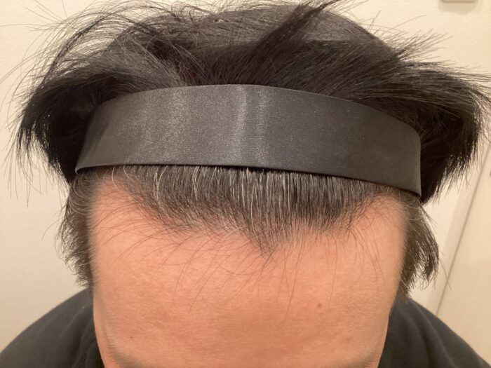 【42歳男性】生え際・頭頂部の薄毛がAGA治療で改善｜大阪梅田院