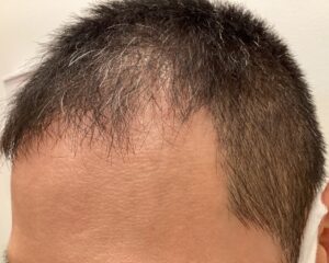 AGA治療前＿40歳男性＿生え際・頭頂部の薄毛＿大阪梅田院