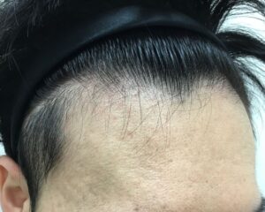 AGA治療前＿27歳男性＿生え際・頭頂部の薄毛＿大阪梅田院