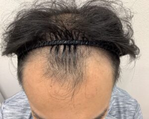 AGA治療前＿34歳男性＿生え際・頭頂部の薄毛＿大阪梅田院