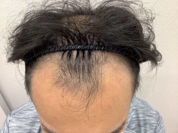 【34歳男性】 生え際と頭頂部の薄毛をAGA治療で改善｜大阪梅田院