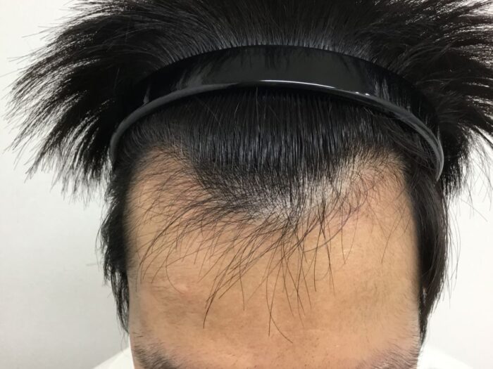 【23歳男性】生え際の薄毛がAGA治療で改善｜大阪梅田院