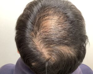 AGA治療前＿４９歳男性＿頭頂部の薄毛＿広島院