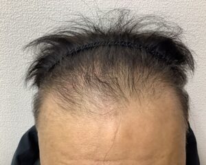 AGA治療後＿59歳男性＿生え際・頭頂部の改善＿広島院