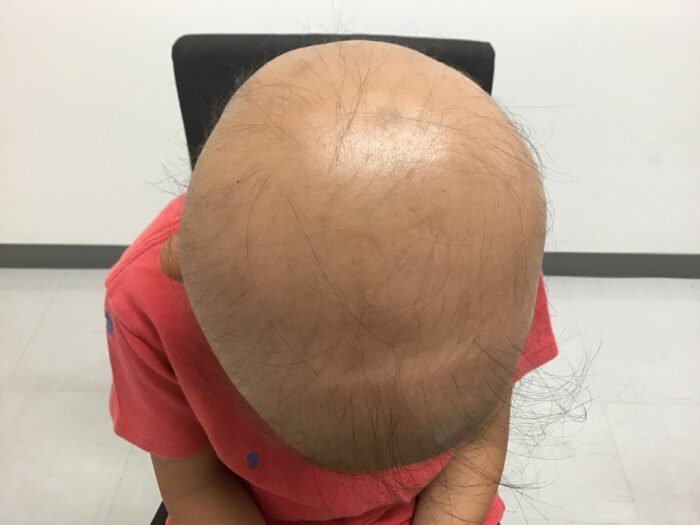 円形脱毛症治療前　5歳男児　汎発型　鹿児島院