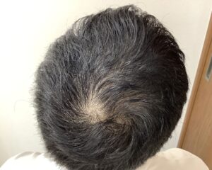 AGA治療後_32歳男性_生え際・頭頂部の改善_広島院