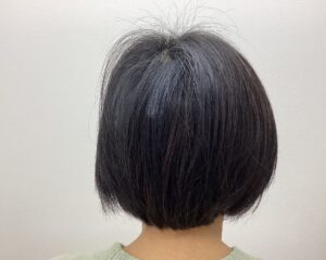 FAGA治療2ヵ月目 49歳女性 分け目の薄毛 横浜院