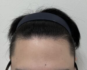 AGA治療前　21歳男性　生え際・頭頂部薄毛　岡山院