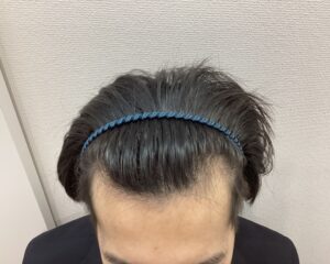 AGA治療前　23歳男性　生え際・頭頂部薄毛　新潟院