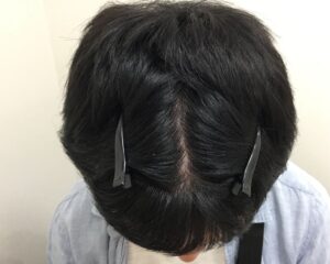 AGA治療後＿35歳男性＿生え際・頭頂部の改善＿大阪梅田院