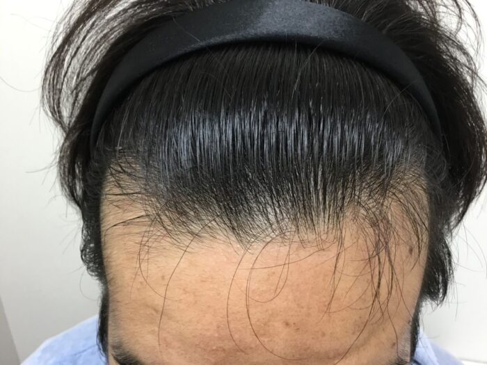 AGA治療後＿25歳男性＿生え際・頭頂部改善＿大阪梅田院