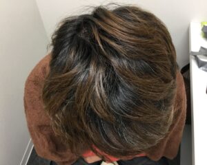 AGA治療後＿34歳男性＿生え際・頭頂部改善＿大阪梅田院