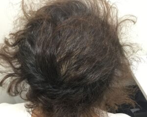 AGA治療後＿38歳男性＿生え際・頭頂部改善＿大阪梅田院