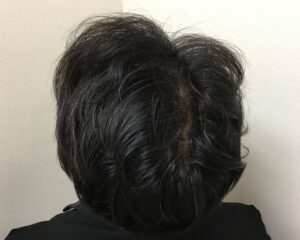 AGA治療後＿33歳男性＿生え際・頭頂部改善＿大阪梅田院