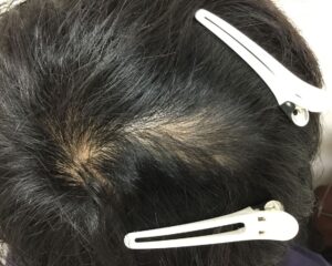 円形脱毛症治療後＿23歳男性＿頭頂部の円形脱毛症の改善＿大阪梅田院