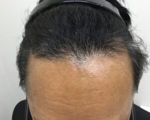 AGA治療後_47歳男性_生え際・頭頂部改善_大阪梅田院