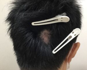 円形脱毛症治療後＿32歳男性＿単発型の円形脱毛症の改善＿大阪梅田院