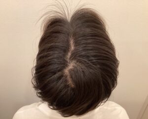 AGA治療後_23歳男性_生え際・頭頂部改善_大阪梅田院