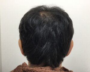 AGA治療後_54歳男性_生え際・頭頂部改善_大阪梅田院