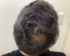 AGA治療後＿56歳男性＿生え際・頭頂部改善＿広島院