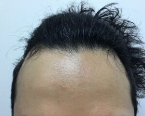 AGA治療後＿34歳男性＿生え際・頭頂部改善＿大阪梅田院