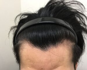 AGA治療後＿29歳男性＿生え際・頭頂部改善＿大阪梅田院