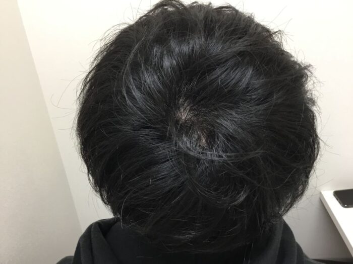 AGA治療後＿25歳男性＿生え際・頭頂部改善＿大阪梅田院