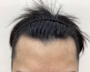 AGA治療3ヵ月目　28歳男性　生え際薄毛　横浜院