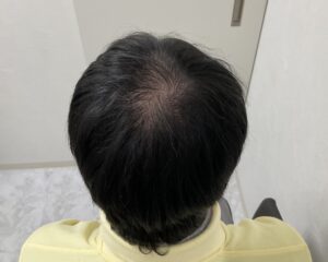 AGA治療12ヵ月後　38歳男性　頭頂部薄毛改善　岡山院