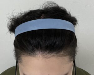 AGA治療12ヵ月後　21歳男性　生え際・頭頂部薄毛改善　岡山院