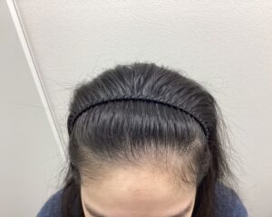 FAGA2年5ヵ月後　29歳女性　生え際・分け目改善　新潟院