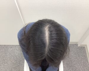 FAGA2年5ヵ月後　29歳女性　生え際・分け目改善　新潟院
