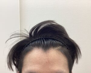 AGA治療5ヵ月後 26歳男性 生え際・頭頂部改善 新潟院