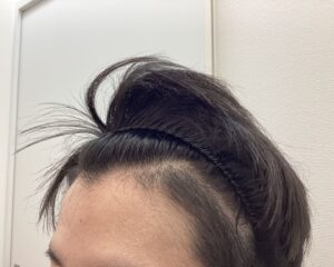 AGA治療5ヵ月後 26歳男性 生え際・頭頂部改善 新潟院